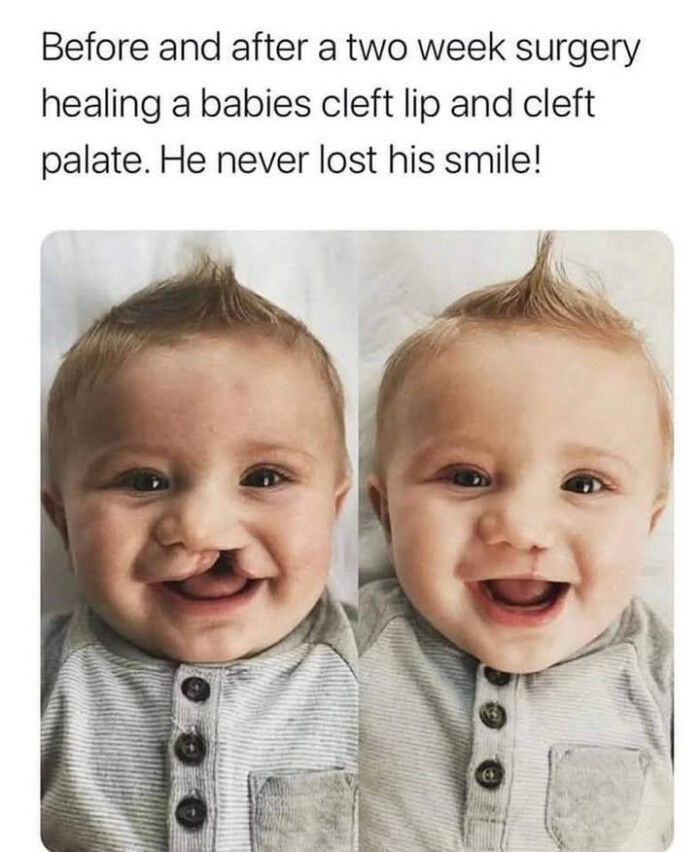 Before and after a two week surgery healing babies cleft lip palate. He never lost his smile!