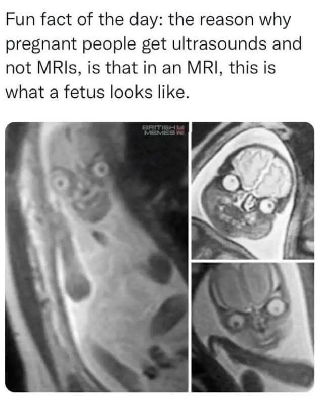 Fun fact of the day: reason why pregnant people get ultrasounds and not MRIs, is that in an MRI, this what a fetus looks like. BRITISHE